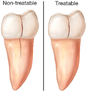 crackedtooth3