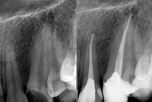 X-ray photos of before and after endo treatment protocol. Black and white photo.X-ray photos of before and after endo treatment