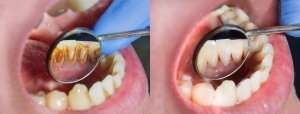 Plaque of the patient, stone. Dentistry treatment of dental plaque, professional oral hygiene. The concept of harm to smoking and cleaning teeth