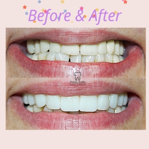 Smile design , fixed denture