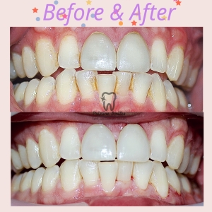 Deep Cleanings to treat gum disease and heavy calculus