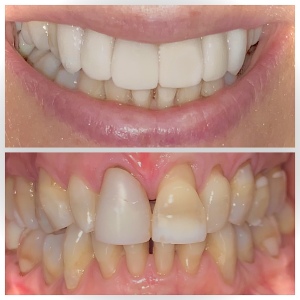 Porcelain Veneers Cosmetic Dentistry Smile Design