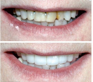 Broken teeth, cracked teeth, dental caries Smile design Veneers Crowns