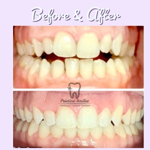 Invisalign clear braces open bite correction