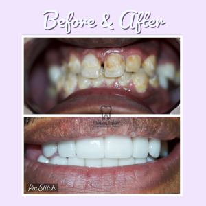 Crowns Veneers to correct dental decay, cavities