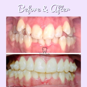 Invisalign correction for crowding