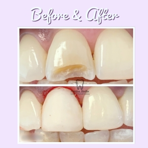 Broken tooth fix with composite resin restoration