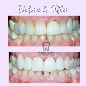 Veneers and crowns to correct cavities and caries