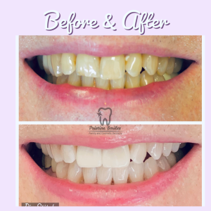 Crowns and veneers and teeth whitening