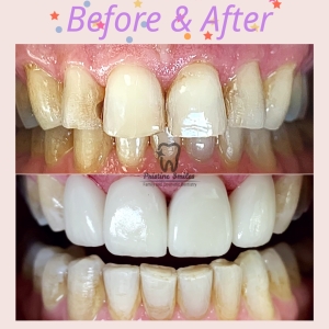 Veneers and teeth whitening