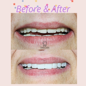 Smile design , crowns , veneers