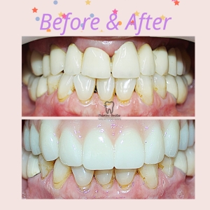 severe bone loss, extractions, fixed implant supported denture