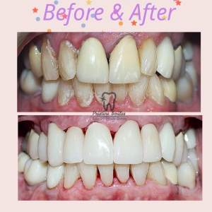 Crowns and Veneers to treat dental caries and cavities