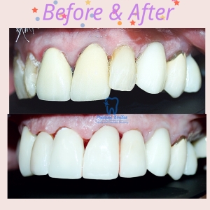 Crowns and veneers to treat cavities and smile design