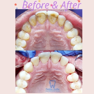 Deep cleanings to treat heavy calculus and gum disease