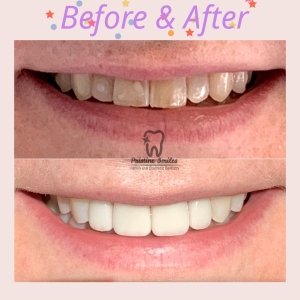 Veneers smile design