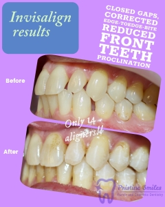 Invisalign clear braces overjet correction