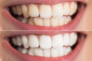 Close-up Detail Of Person Teeth Showing Before And After Whitening